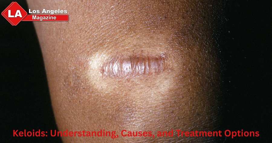 Keloids: Understanding, Causes, and Treatment Options