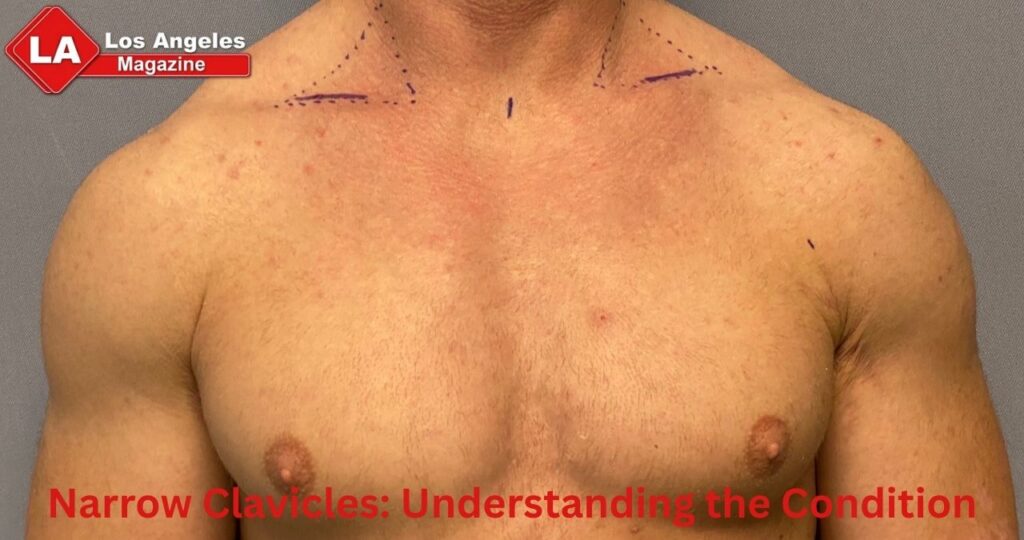 Narrow Clavicles: Understanding the Condition