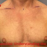 Narrow Clavicles: Understanding the Condition