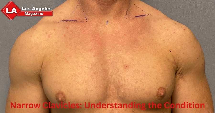 Narrow Clavicles: Understanding the Condition Narrow Clavicles: Understanding the Condition