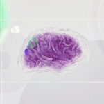 How the NeuroPace RNS System Helps Control Epileptic Seizures